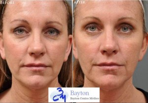 Tratamiento facial con Botox o Toxina Botulínica