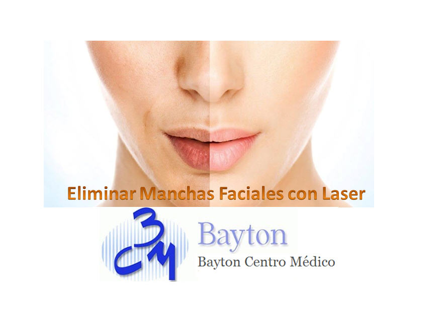 artillería Comerciante itinerante Barbero Eliminar manchas faciales con laser | Clinica Bayton